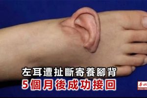 चिनियाँ युवतीले ५ महिनासम्म खुट्टामै पालिन् चुँडिएको आफ्नो कान !